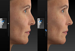 Visia 3D Canfield