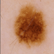 D2 Dermagraphix 3